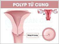 Polyp tử cung là gì? biểu hiện nhận biết bệnh sớm nhất