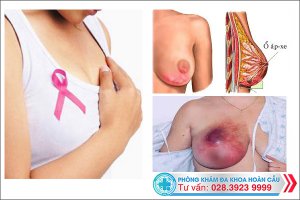 Áp xe vú ở phụ nữ: Nguyên nhân, biểu hiện và cách chữa trị