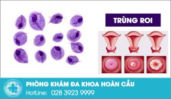 Bệnh trùng roi dễ lây lan khó điều trị
