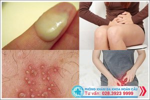 Dấu hiệu bệnh viêm âm đạo điển hình bạn gái nào cũng nên biết