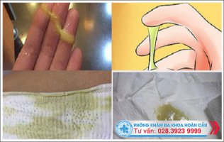 Huyết trắng có màu xanh nhạt có nguy hiểm không?