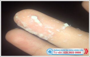 Ra khí hư màu trắng có bình thường không?