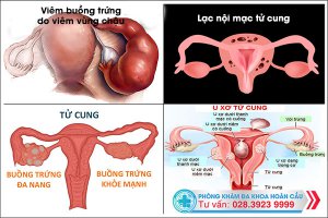 Kinh nguyệt không đều là dấu hiệu của bệnh gì và cách chữa trị đáng tin cậy