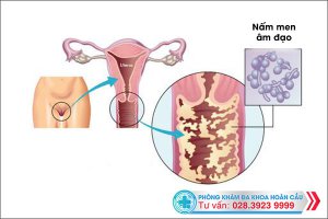 Hé lộ nguyên nhân nhiễm nấm men âm đạo kéo dài và cách trị không lo tái bệnh