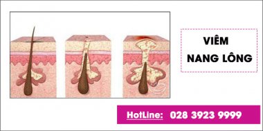 Nỗi mụn ở vùng kín nữ: dấu hiệu về những bệnh lý bất thường