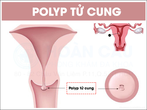 Polyp tử cung là gì? biểu hiện nhận biết bệnh sớm nhất